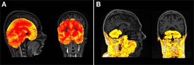 Recommendations for the Use of Automated Gray Matter Segmentation Tools: Evidence from Huntington’s Disease